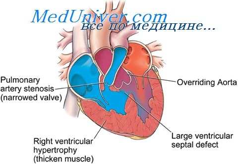 виды трикуспидальной атрезии