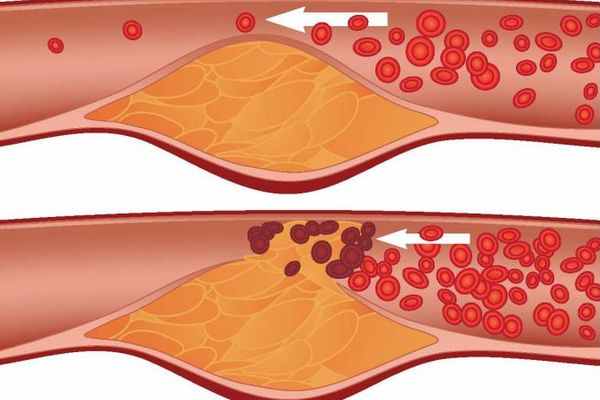 Гиперхолестеринемия
