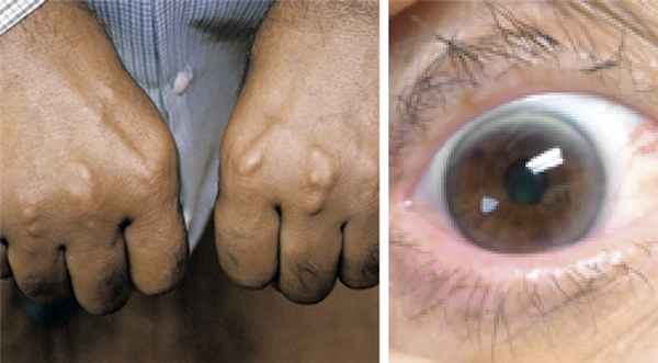 Клинические проявления