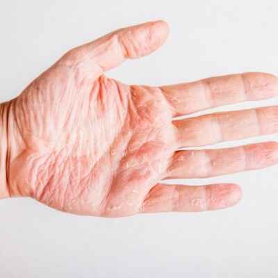 Ангидроз и гипогидроз