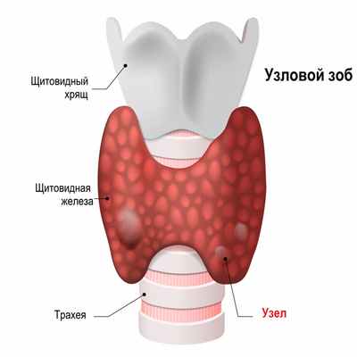 Узловой зоб.jpg