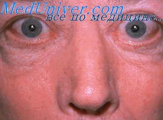 феномен хегглина при тиреотоксикозе