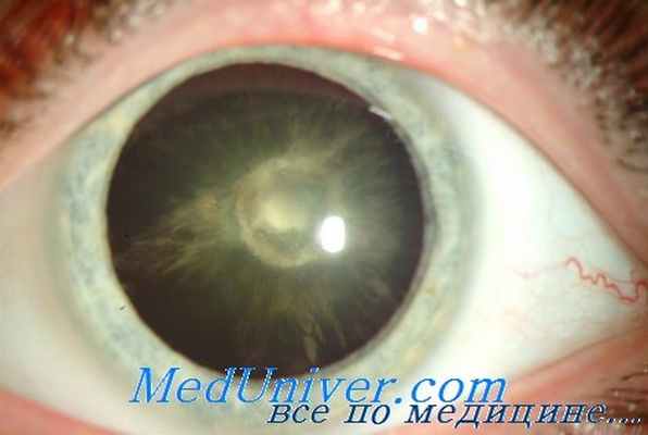 гипопаратиреоидная катаракта