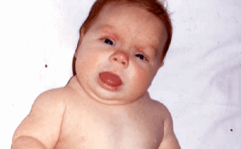 Врожденный гипотиреоз: причины, и лечение