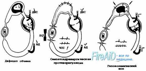 Гиповолемический ( постгеморрагический ) шок. Этиология гиповолемического шока.