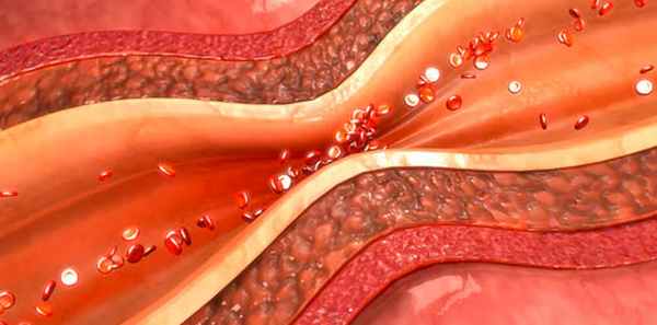 Спазмов мелких сосудов – Алкоклиник