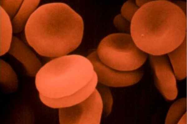 Гиповолемия: определение, причины, симптомы, диагностика и лечение