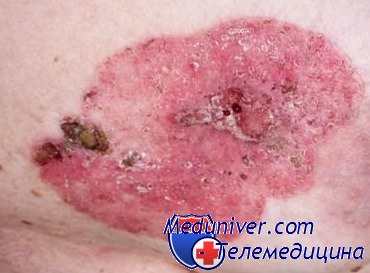 себорейная карцинома