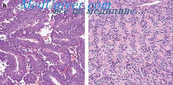 синовиальная саркома