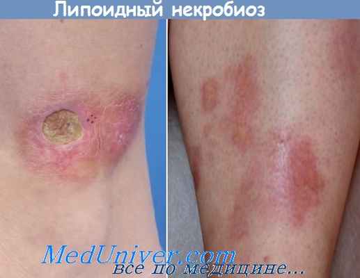 липоидный некробиоз