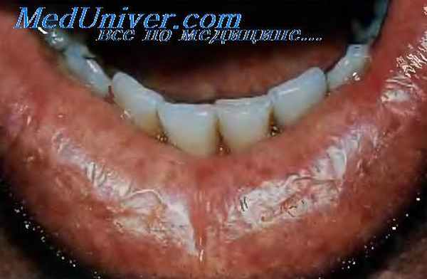 гландулярный хейлит