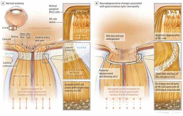 Строение глаза при глаукоме