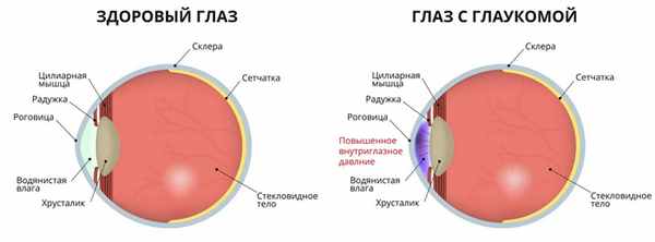 глаукома