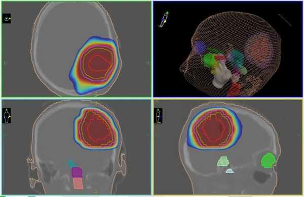 Цифровой трехмерный план лечения глиобластомы на линейном ускорителе