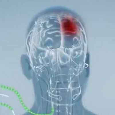 глиобластома головного мозга