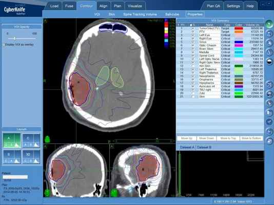 План лечения глиобластомы на КиберНоже (радиохирургия)