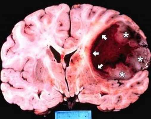 Мультиформная глиобластома