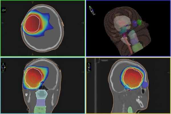 План лучевого лечения глиомы на линейном ускорителе в Клинике Спиженко