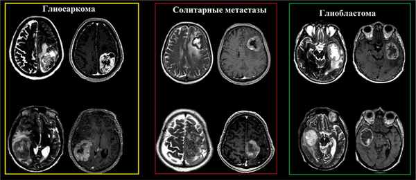 радиология глиосаркома
