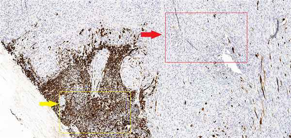 радиология глиосаркома