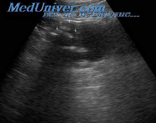 гломерулонефрит