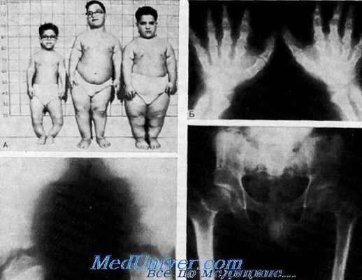 глухота с умственной отсталостью