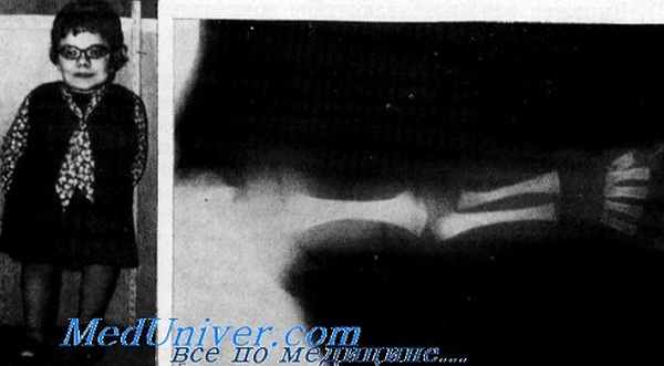 спондило-эпифизарная дисплазия