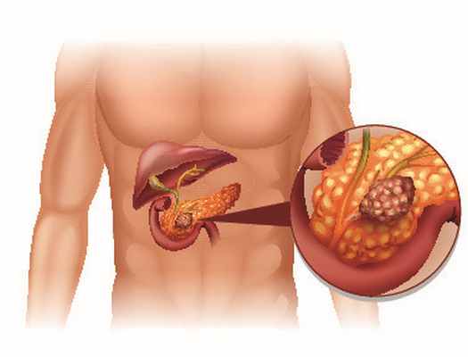 Лечение глюкагономы в Германии