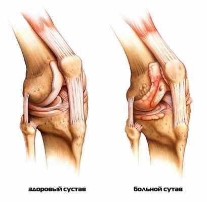 Что такое глюкозамин? 1