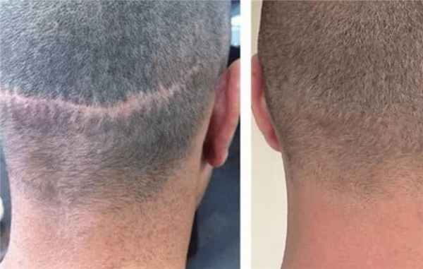 рубцовая алопеция.jpg