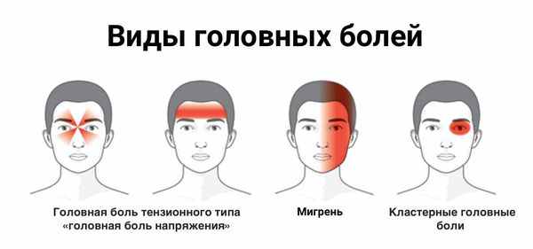 Локализация различных видов головной боли
