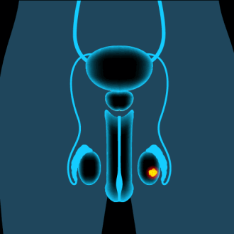 Опухоль яичка