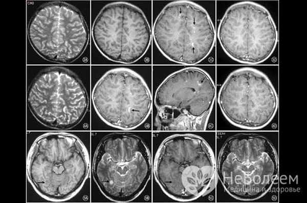 Гнойный менингоэнцефалит