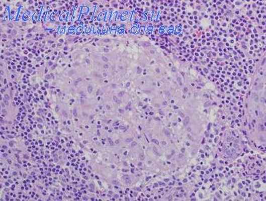 Патоморфология саркоидоза