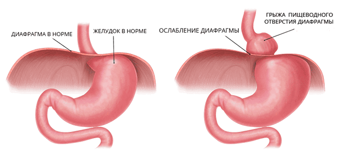 грыжа пищеводного отверстия диафрагмы.png
