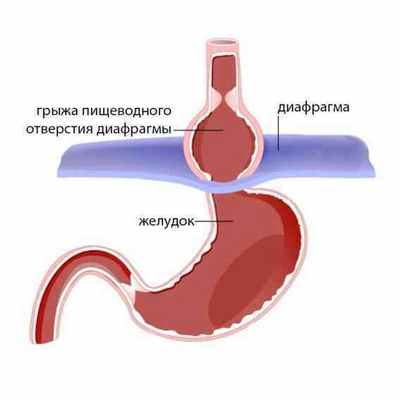 Грыжа пищеводного отверстия диафрагмы