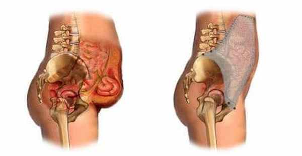 лечение грыжи.jpg