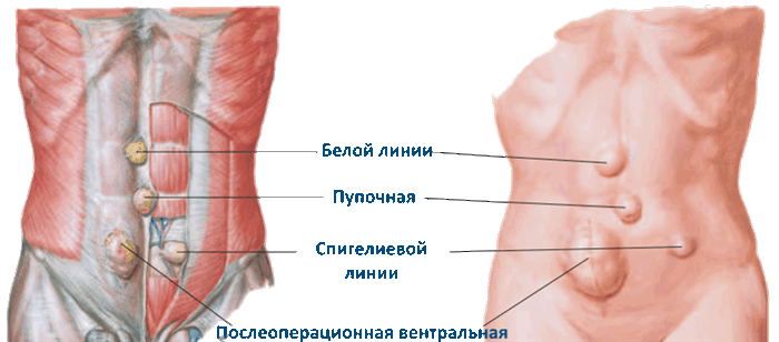 Грыжи передней брюшной стенки