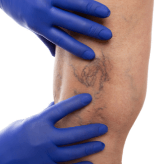 Сосудистые звездочки