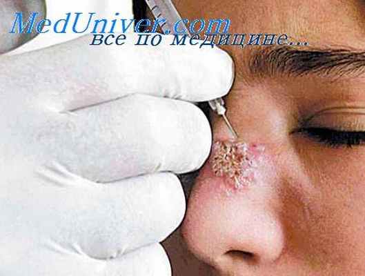 кожный лейшманиоз