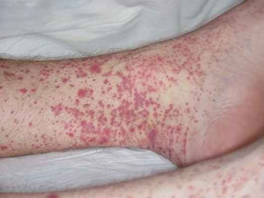 Продуктивные тромбоцитопении