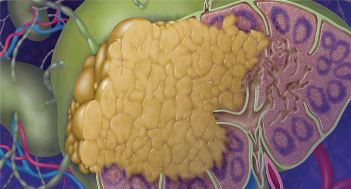 Фолликулярная лимфома