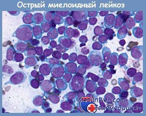 острый миелоидный лейкоз