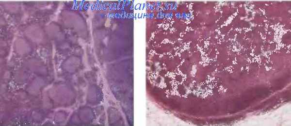 фолликулярная лимфома