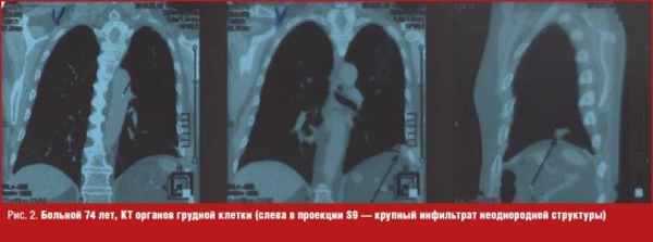 Больной 74 лет