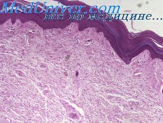 келоидный фолликулит