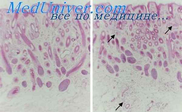 лейкоплакия вульвы и беременность