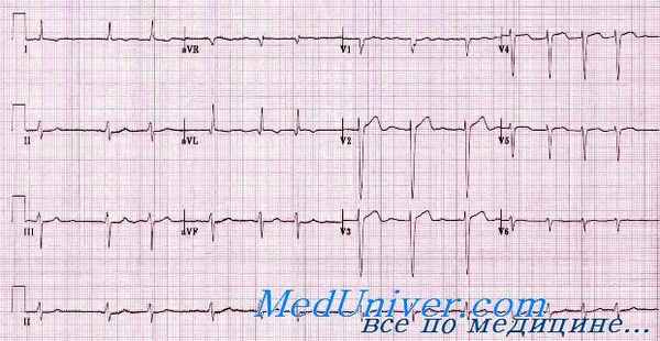 аритмии на ЭКГ