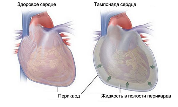 Тампонада сердца — симптомы и лечение