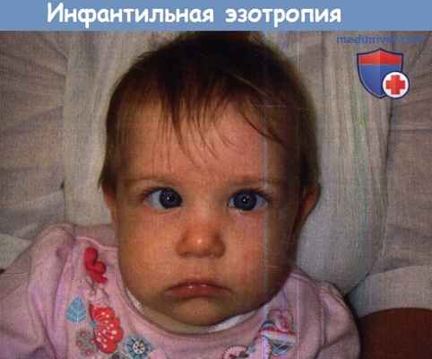 Инфантильная эзотропия (сходящееся косоглазие)